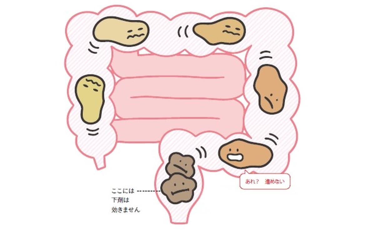 肛門科医が警鐘を鳴らす「慢性的な便秘」につながるNG習慣のサムネイル